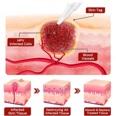 Wart Removing Pen